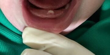 Bebê nasce com dente em Barbacena