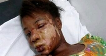 Mulher é brutalmente agredida e queimada com óleo quente