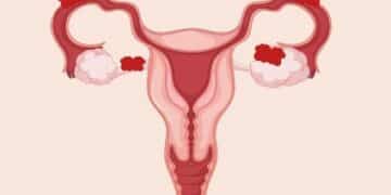 As 5 principais dúvidas das mulheres sobre a endometriose