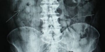 Paciente internada é suspeita de ter engolido droga para fugir de flagrante