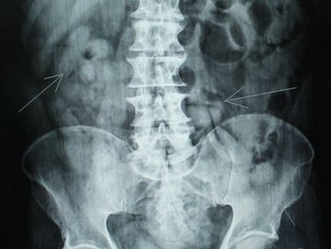 Paciente internada é suspeita de ter engolido droga para fugir de flagrante