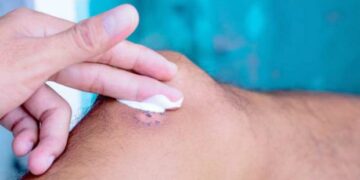 12 Pomadas Cicatrizantes Mais Conhecidas – Como Usar e Dicas